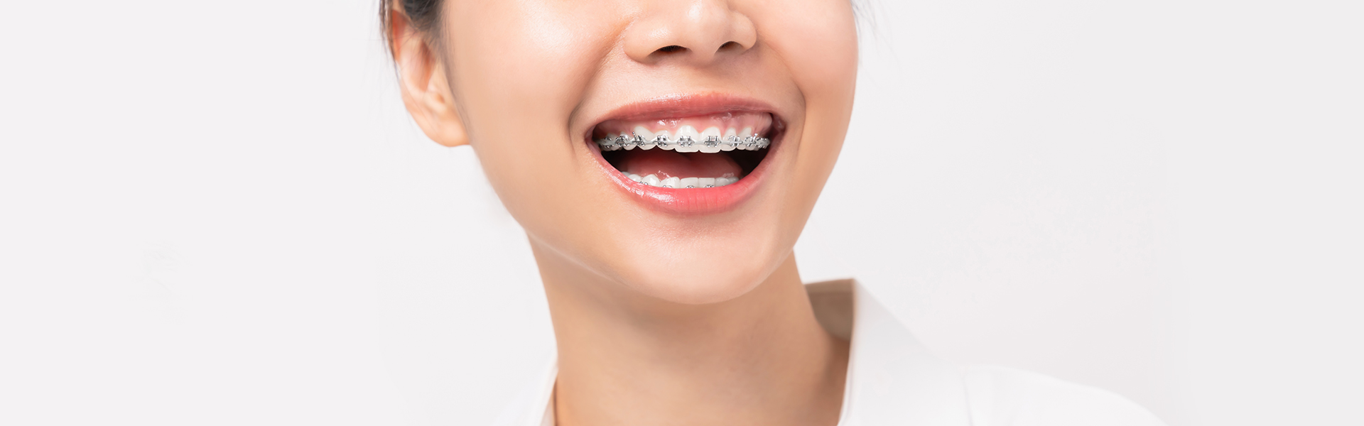 Fastbraces® – A Revolutionary Method to Straighten Teeth
