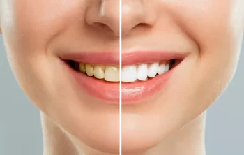 Teeth Turning Yellow Suddenly? Common Causes You Should Know